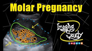 Molar Pregnancy  Hydatidiform Mole  Ultrasound  Case 281 [upl. by Ronoh]