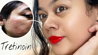 TRETINOIN Before amp After  My skin Transformation with Tretinoin pimple acnetreatment [upl. by Luahs]