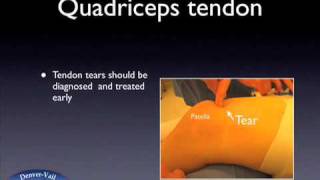 Quadriceps Tendon Tear [upl. by Eicirtap]