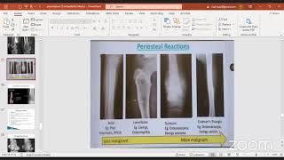 Osteosarcoma amp Ewing Sarcoma [upl. by Fallon]