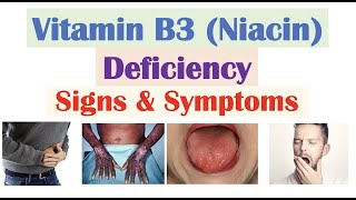 Vitamin B3 Niacin Deficiency Signs amp Symptoms Skin Hair Gastrointestinal Psychiatric [upl. by Aymik]