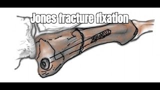 Jones Fractureproximal fifth metatarsal  Everything You Need To Know  Dr Nabil Ebraheim [upl. by Ayanaj340]