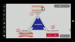 Virchows Triad Thrombosis General Pathology [upl. by Dorahs]