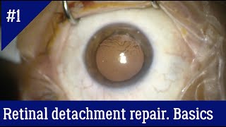 The general principles of vitrectomy for retinal detachment repair [upl. by Georgeanna]