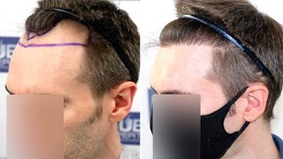 FUE Hair Transplant 1500 Grafts NW III A By Dr Juan Couto  FUEXPERT CLINIC Madrid Spain [upl. by Achorn]