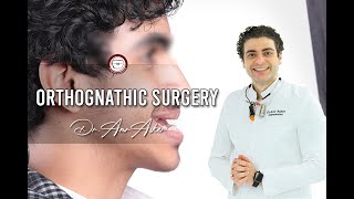 Orthognathic Surgery [upl. by Airdnat]