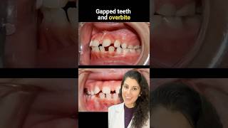 Teeth gap treatment with Braces shorts viralvideo dental trending braces invisalign aligners [upl. by Tris920]