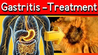 Top 5 Signs You Have Gastritis Ultimate Guide to Gastritis Symptoms Causes and Treatments [upl. by Arreit]