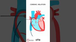 Cardiac Ablation cardiology [upl. by Zanahs]