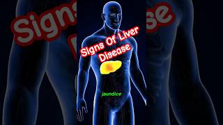 Liver Disease Warning Signs  Liver Disease Symptoms  Liver Damage  Acute Liver Failure [upl. by Cuda]