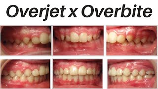 Overjet x Overbite  explicação [upl. by Ahsiken]