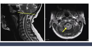 Optimizing Alignment Occipitocervical Instability 2024 [upl. by Ettevram]