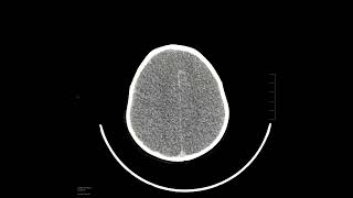 Anoxic brain injury with pseudosubarachnoid hemorrhage [upl. by Adnuahsar]