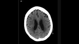 Subarachnoid Hemorrhage [upl. by Ecyned]