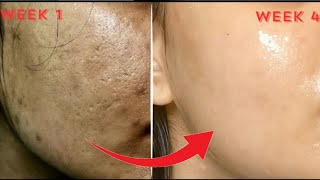 How to Get Rid of Acne Scars [upl. by Hillier954]