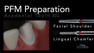 PFM Preparation on Mandibular Canine  Acadental Tooth 22 [upl. by Eimrots]