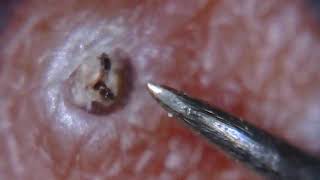 Itchy ingrown hair removed [upl. by Adnirolc]