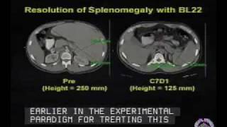 Updates on Therapies for Hairy Cell Leukemia [upl. by Darwin]