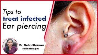 How to treat infected Ear Piercing  Timesxp [upl. by Airekal]