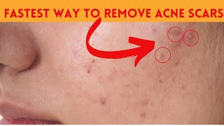 Experts Agree This is the FASTEST Way to Remove Acne Scars [upl. by Mcnelly35]