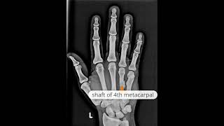 Metacarpal fractures l fractures of the shaft of 4th metacarpal and neck of 5th metacarpal [upl. by Sherlock]