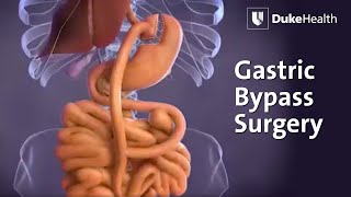 Gastric Bypass Surgery  Duke Health [upl. by Tedmann]