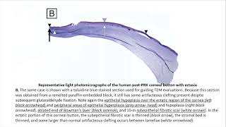 Corneal Ectasia Basics – A Deep Dive [upl. by Craw]