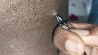 ASMR removing ingrown hairs arrachage de poils incarnés [upl. by Hoffer515]