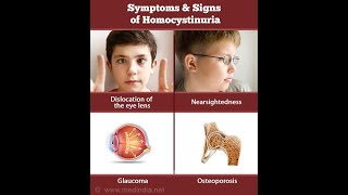 Homocystinuria Cuases Diagnosis and Treatment [upl. by Anabal]