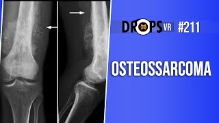 OSTEOSSARCOMA  RECONHECENDO NOS RAIOSX [upl. by Berky]