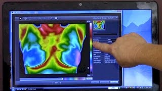 WHAT IS THERMOGRAPHY INTERVIEW WITH BOSTON THERMOGRAPHY CENTER  Cancer Education amp Research Inst [upl. by Rheta]