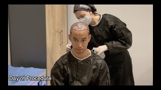 Cosmedica Hair Transplant VLOG Week 1 [upl. by Alf]