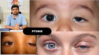 Ptosis and its classification drhashimjabbar education optometry eye ptosis [upl. by Kalindi]