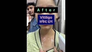 Vitiligo Treatment in Allopathy Effective Solutions and Tips fasttreat  Dr Aniket Prakash [upl. by Ddet]