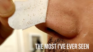 ASMR blackhead removal nose strip on face for skincare satisfying [upl. by Richer]