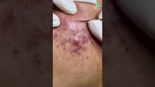 Inflamed Acne and Blackhead Removal CloseUp Secrets to Clear and Smooth Skin [upl. by Turoff]