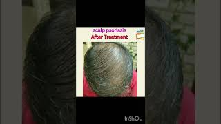 Scalp Psoriasis Before and After Treatment psoriasis psoriasis psoriasiscure [upl. by Azila]