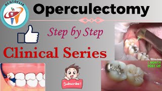 Operculectomy  Step by Step  Clinical Series [upl. by Aneles728]