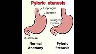 Pyloric stenosis Fluid calculation mrcpch Recall Communication [upl. by Olia]