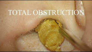 TOTAL OBSTRUCTION  EAR WAX REMOVAL  4KHD [upl. by Seka]