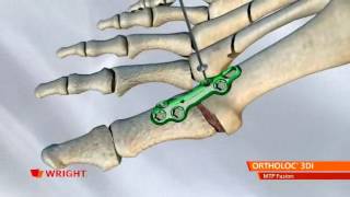 Wright  Ortholoc 3DI MTP Fusion NEW [upl. by Johnnie]