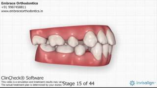 Extraction space closure with Invisalign India [upl. by Radnaskela]