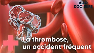 Thrombose  toutes vos questions  Allo Docteurs [upl. by Sarchet342]