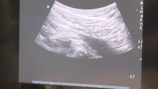 Trigger Point Injections  Ultrasound Guided [upl. by Inaliak]