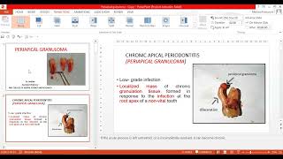 Periapical Granuloma [upl. by Regan]