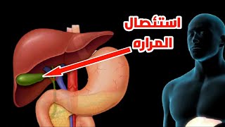 شاهد عملية استئصال المراره بشكل3d انيميشنGallbladder removal surgery in 3D animation [upl. by Carlyle282]