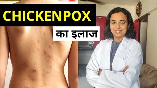 Chickenpox Treatment in Hindi  Chicken Pox का इलाज कैसे करें [upl. by Wennerholn249]