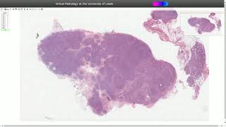 Histopathology  Toxoplasma Lymphadenitis [upl. by Anisah]