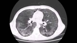 PNEUMOCYSTIS JIROVECI PNEUMONIA [upl. by Alial]