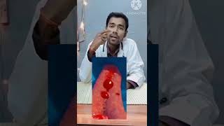 How to stop nose bleeding explained by drrk sharma doctor drrksharma fmge nosebleed [upl. by Aaren]